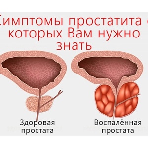 Prostatitis